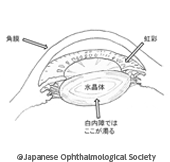 白内障の治療